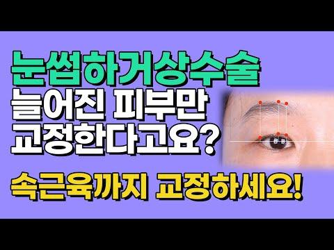 셀라성형외과★눈썹하거상수술 늘어진 피부만 교정한다고요? 반드시 속근육까지 교정하세요 #상안검수술 #눈매교정 #눈썹거상술 #동안성형