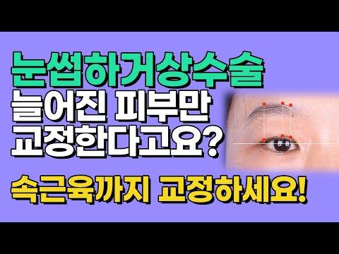 셀라성형외과★눈썹하거상수술 늘어진 피부만 교정한다고요? 반드시 속근육까지 교정하세요 #상안검수술 #눈매교정 #눈썹거상술 #동안성형